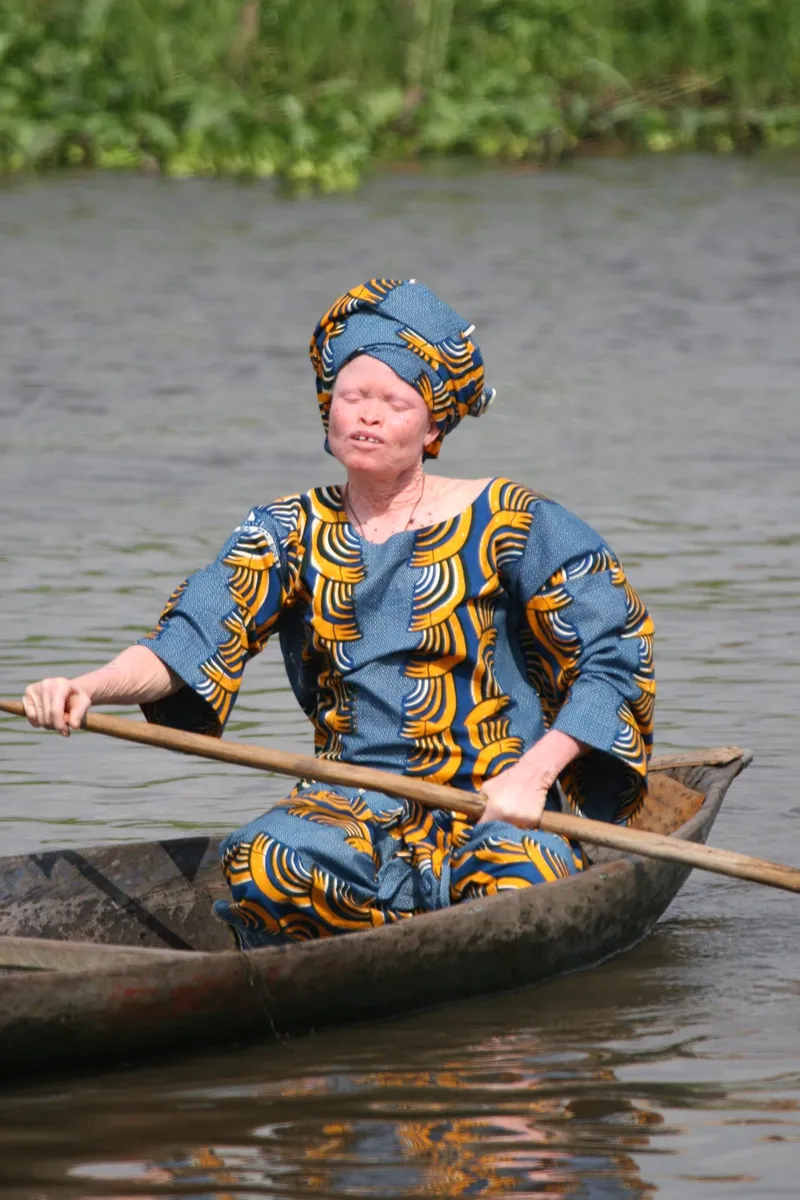 Tanzania's Trade in Albino Body Parts, and the Superstition Behind It